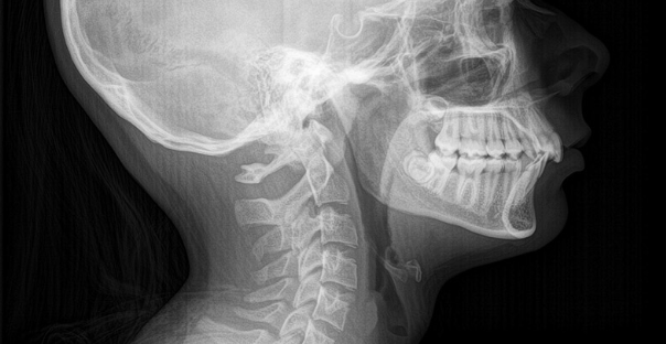 Upper Cervical Spine Chiropractic Care: Dr. Vince Hassel in West Des Moines, IA Explains